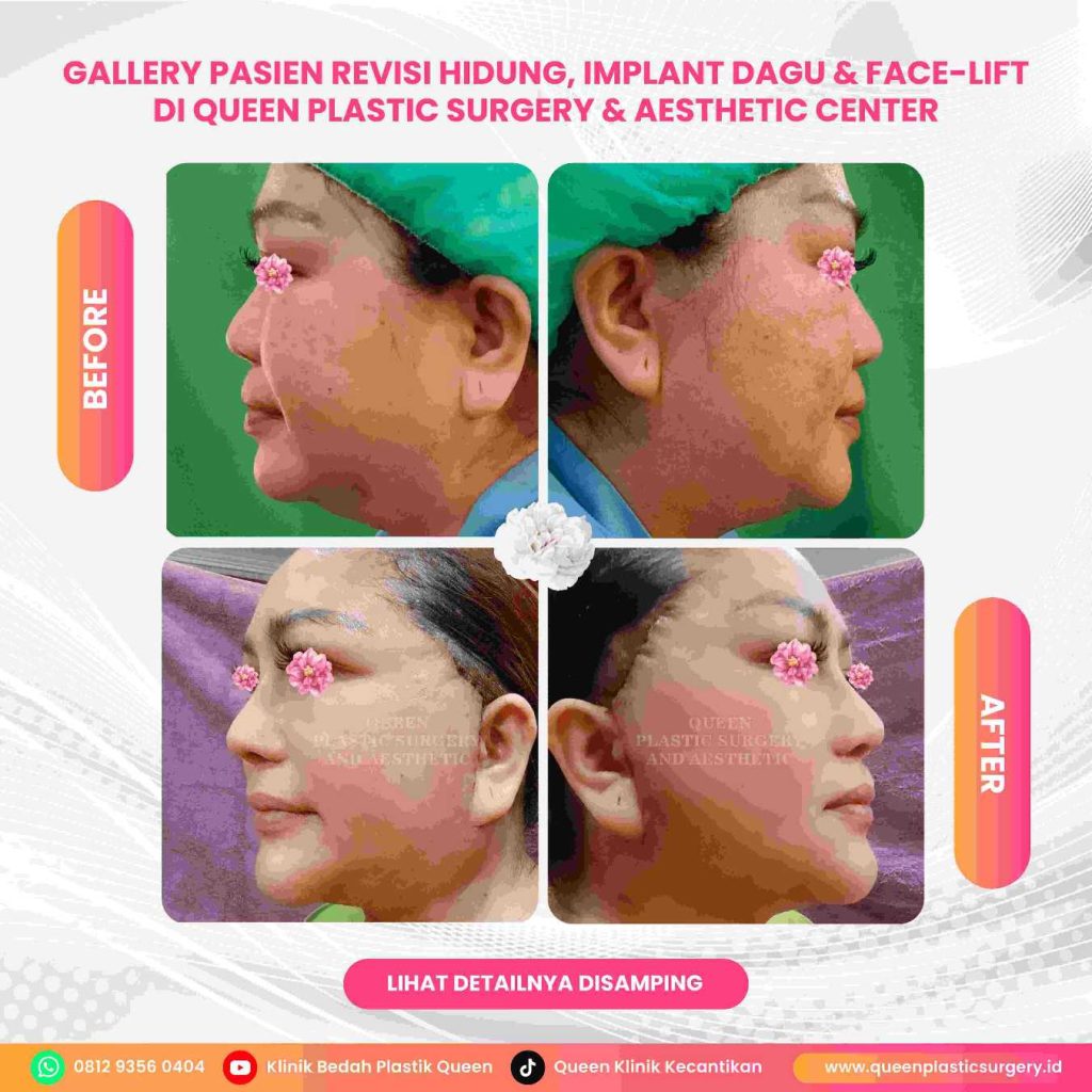 Apa Yang Dimaksud Dengan Facelift yang Gagal? Ketahui Tanda dan Cara Mencegahnya