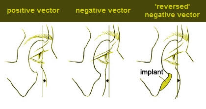 Augmentasi Tepi Infraorbital (Implan): Solusi Efektif untuk Mata Lebih Cerah dan Wajah Lebih Muda