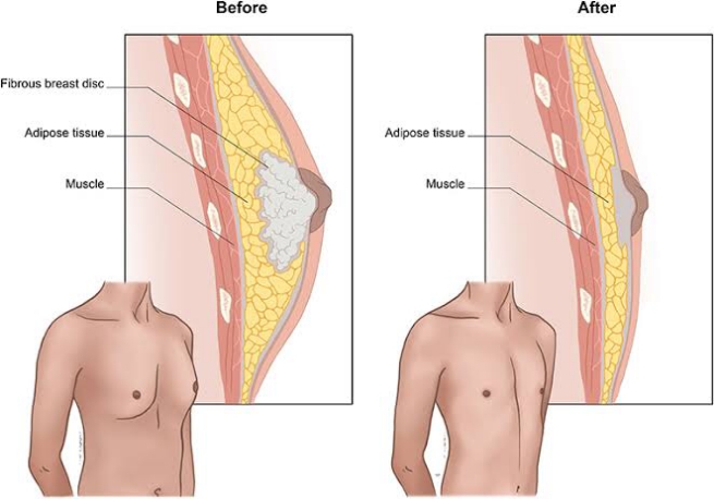 Ginekomastia Setelah Penurunan Berat Badan: Mengapa Terjadi dan Bagaimana Mengatasinya?