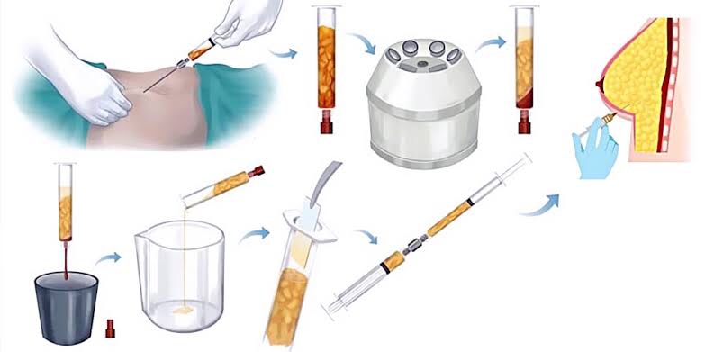 Miliki Payudara Ideal Tanpa Implan: Cara Kerja dan Hasil Optimal Pembesaran Payudara dengan Transfer Lemak