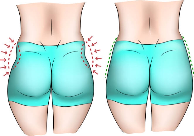 Mengenal Operasi Hip Dip Solusi Efektif untuk Bentuk Panggul Lebih Sempurna