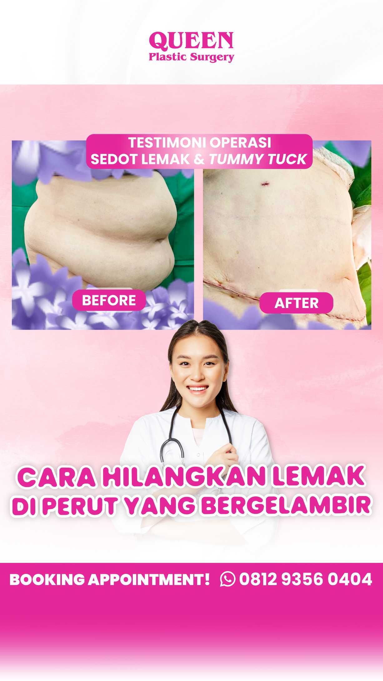 Mengapa Lipatan Perut Bisa Muncul Setelah Operasi Pengencangan Perut? dan Bagaimana Cara Mengatasinya?