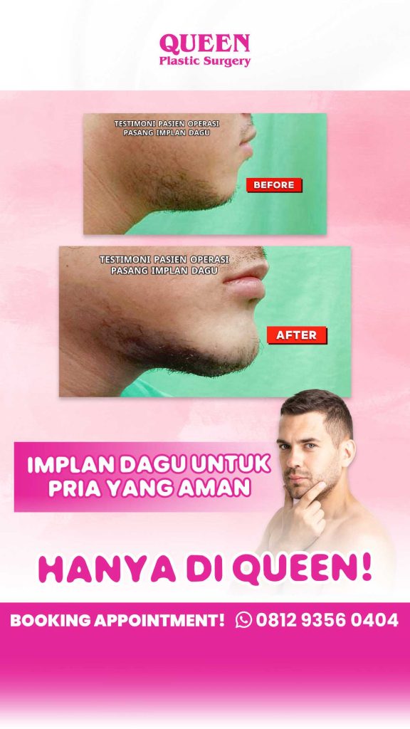 Dagu Ideal & Wajah Lebih Harmonis dengan Implan Dagu