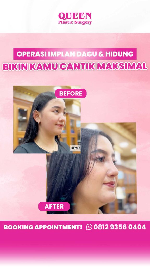 Dagu Ideal & Wajah Lebih Harmonis dengan Implan Dagu