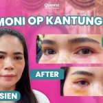 Goodbye Festoon! Mengupas Tuntas Tampilan Pembengkakan di Bawah Mata dan Cara Menghilangkannya