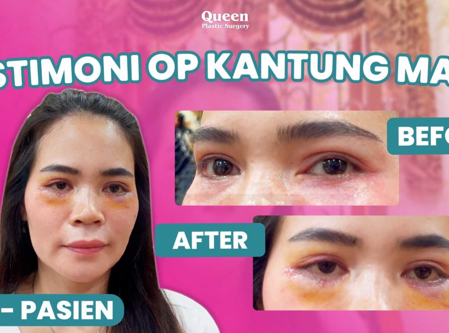 Goodbye Festoon! Mengupas Tuntas Tampilan Pembengkakan di Bawah Mata dan Cara Menghilangkannya