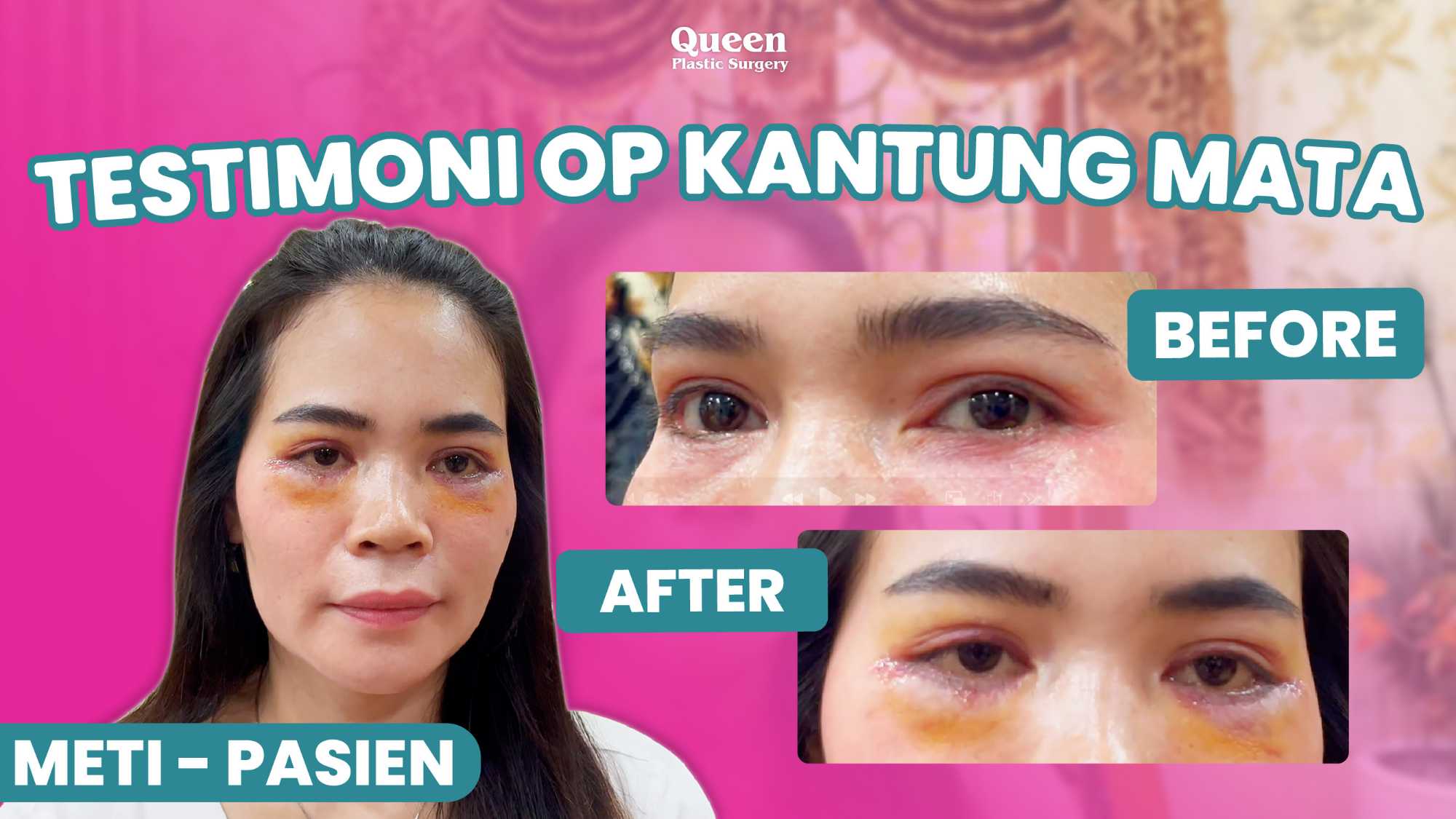 Goodbye Festoon! Mengupas Tuntas Tampilan Pembengkakan di Bawah Mata dan Cara Menghilangkannya