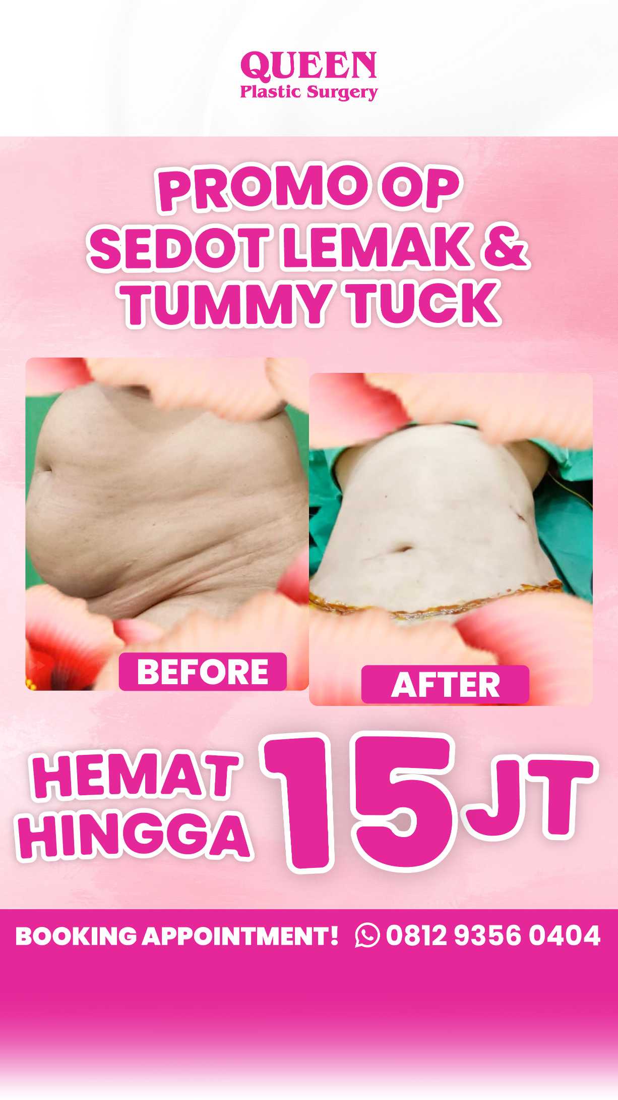 Mengapa Lipatan Perut Bisa Muncul Setelah Operasi Pengencangan Perut? dan Bagaimana Cara Mengatasinya?
