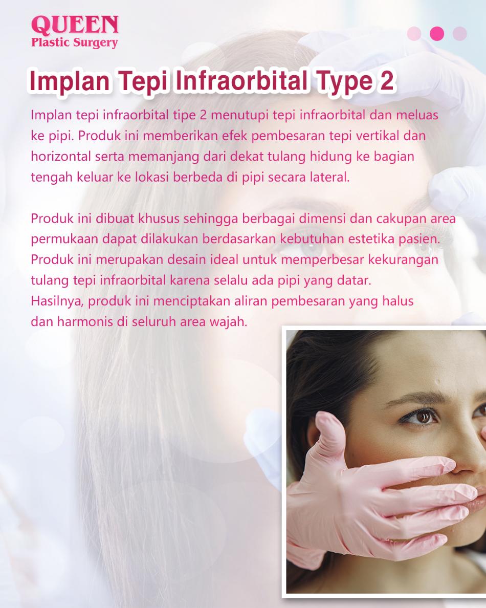 Memahami Bentuk dan Indikasi Implan Tepi Infraorbital Untuk Solusi Mata Cekung