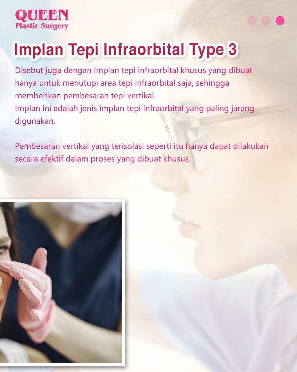 Memahami Bentuk dan Indikasi Implan Tepi Infraorbital Untuk Solusi Mata Cekung