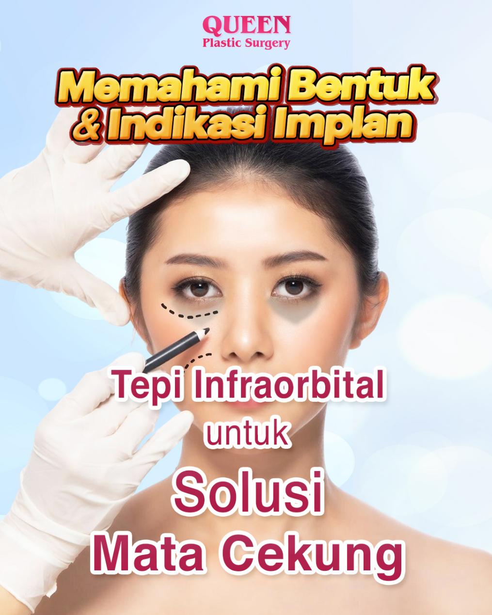 Augmentasi Tepi InfraorbitalMemahami Bentuk dan Indikasi Implan Tepi Infraorbital Untuk Solusi Mata Cekung (Implan): Solusi Efektif untuk Mata Lebih Cerah dan Wajah Lebih Muda