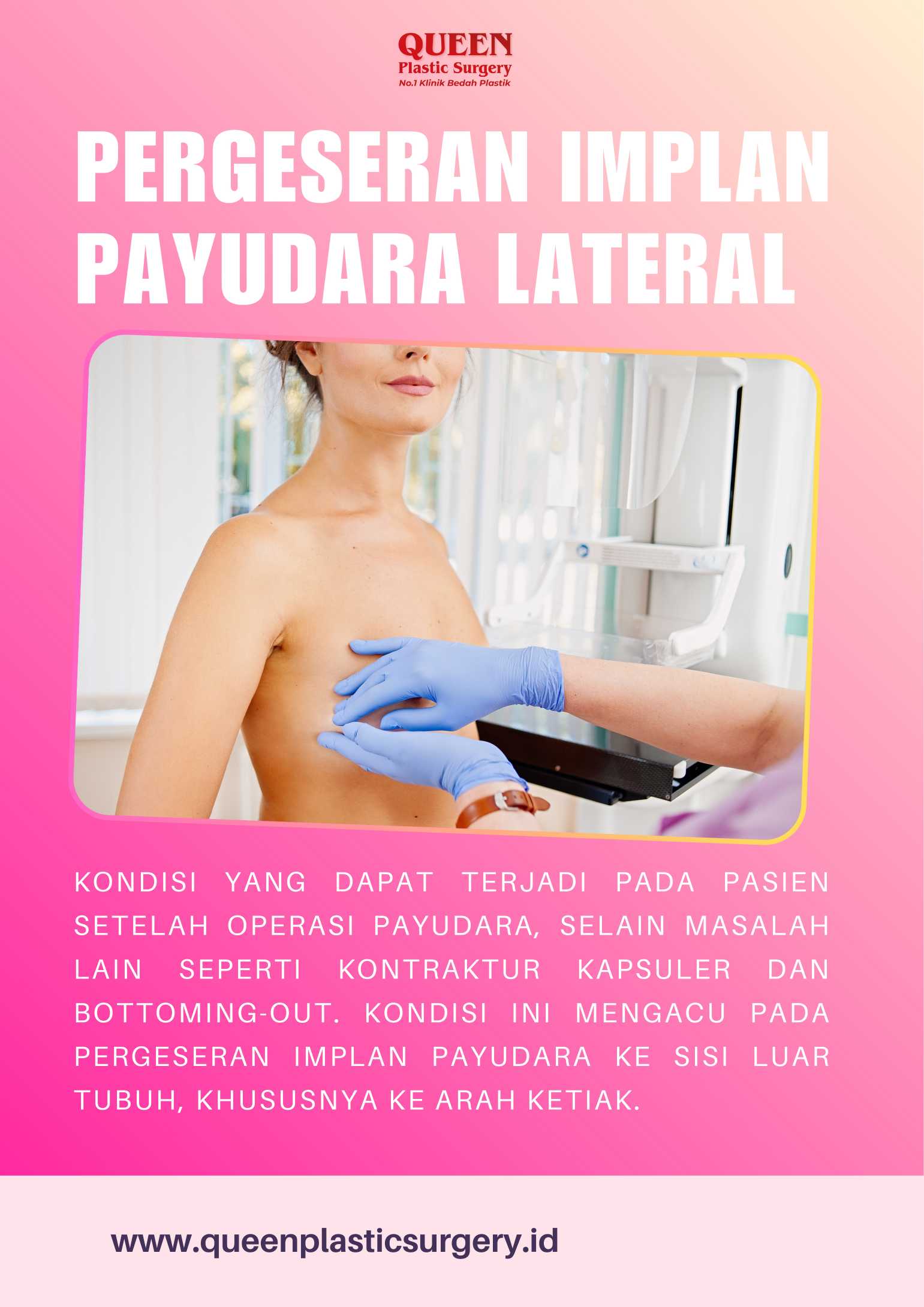 Implan Payudara Bergeser ke Luar? Pahami Cara Mengatasi Pergeseran Implan Payudara