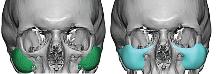Memahami Bentuk dan Indikasi Implan Tepi Infraorbital Untuk Solusi Mata Cekung