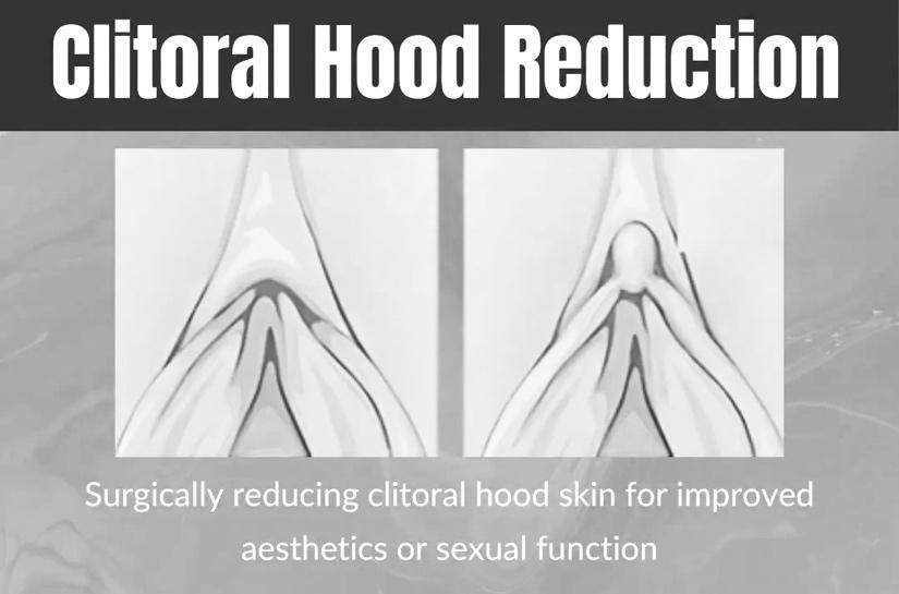 Pilih Mana? Hoodectomy atau Labiaplasty: Panduan Lengkap Perbedaan dan Keputusan Ideal