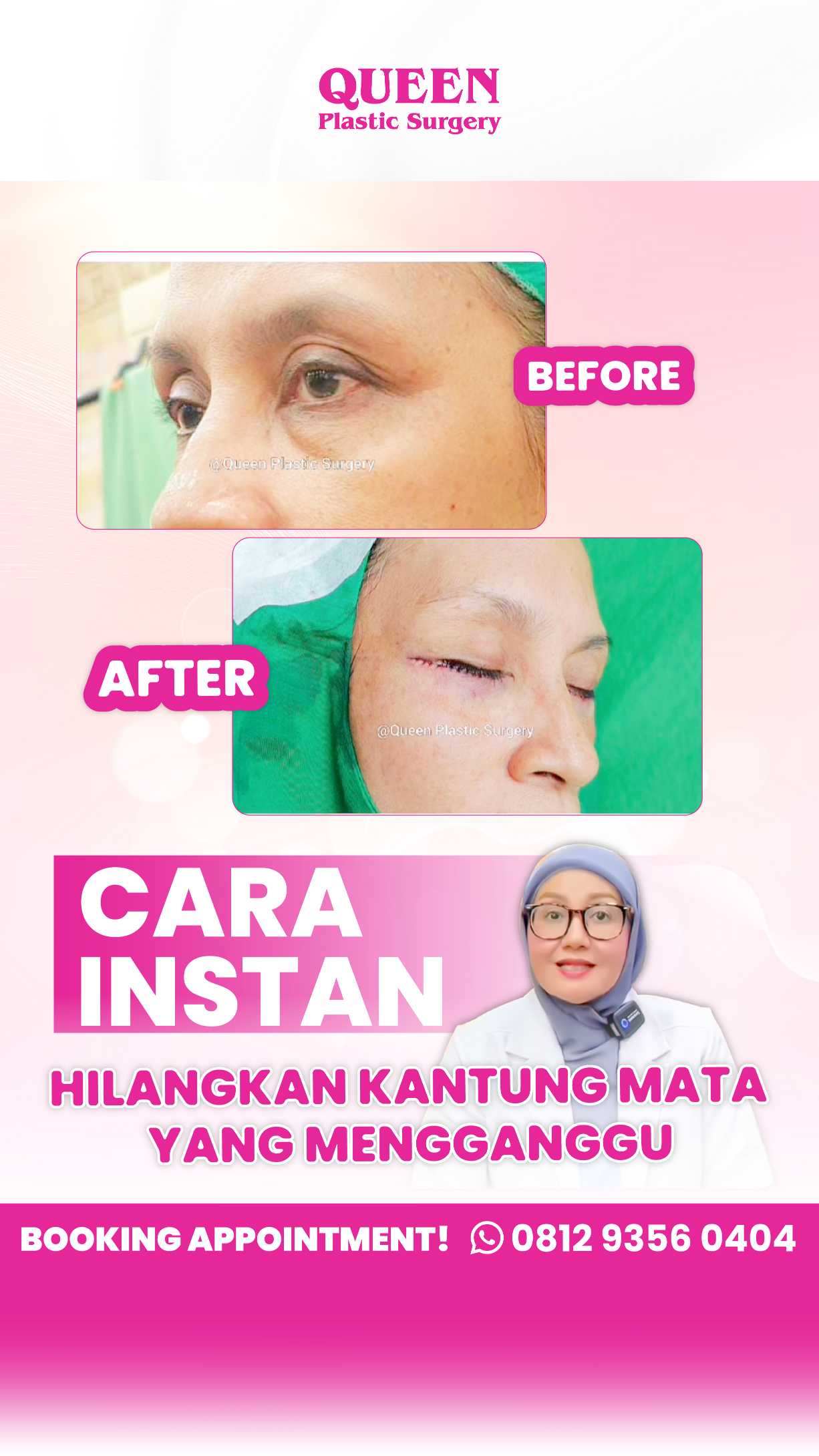 Bye Kantung Mata! Kenali Prosedur Transfer Lemak di Bawah Mata untuk Mengembalikan Kesegaran Wajah