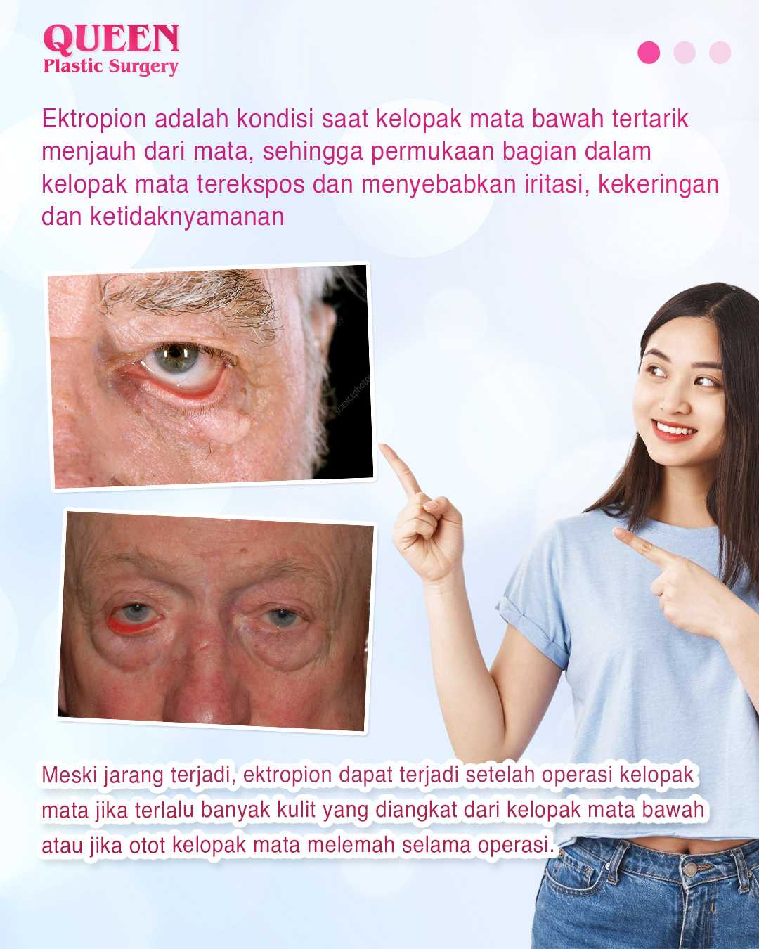 Ektropion, Komplikasi Operasi Kelopak Mata Bawah yang Berdampak pada Kesehatan Mata