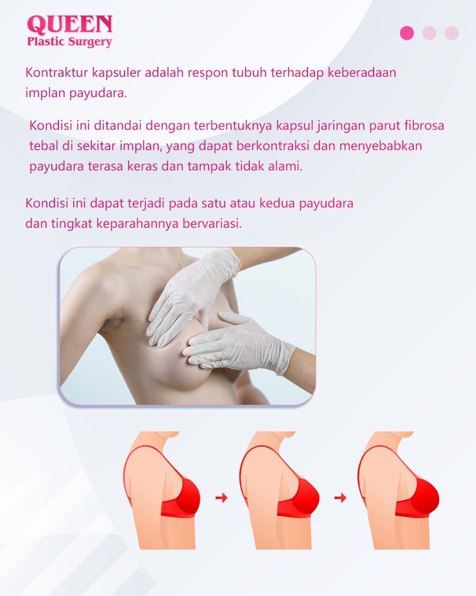 Mengupas Tuntas Kontraktur Kapsuler: Kenali Gejala dan Solusi Penanganannya