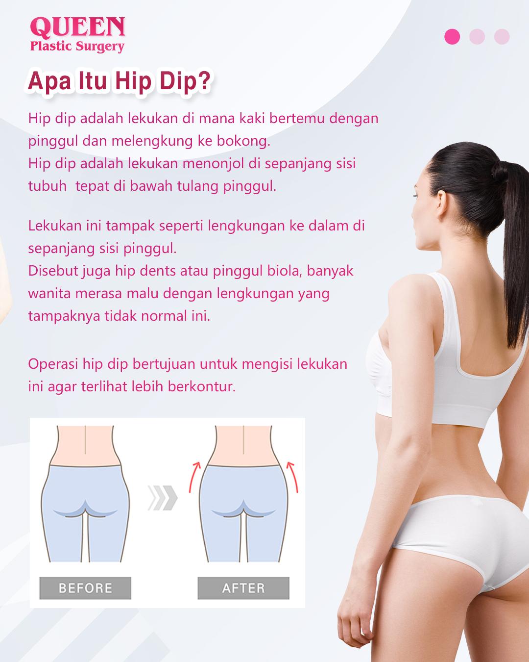 Mengenal Operasi Hip Dip Solusi Efektif untuk Bentuk Panggul Lebih Sempurna