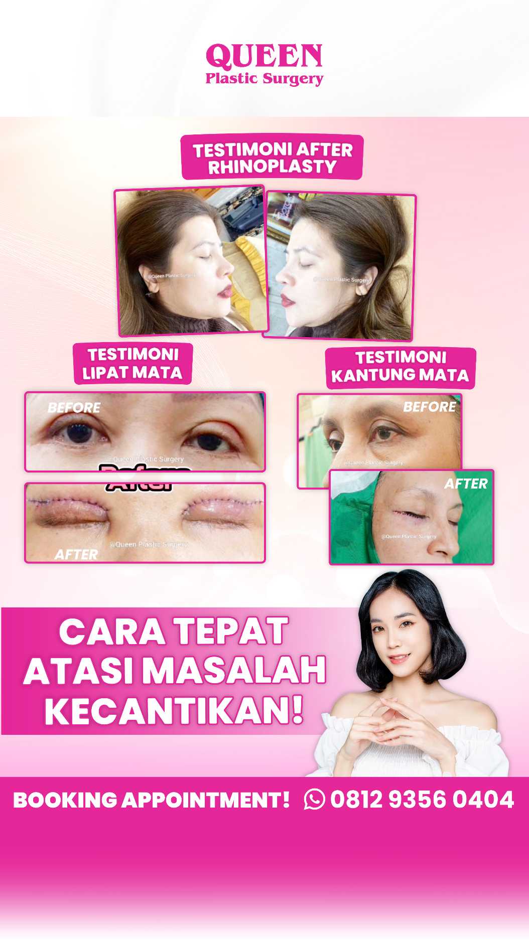 Bye Kantung Mata! Kenali Prosedur Transfer Lemak di Bawah Mata untuk Mengembalikan Kesegaran Wajah