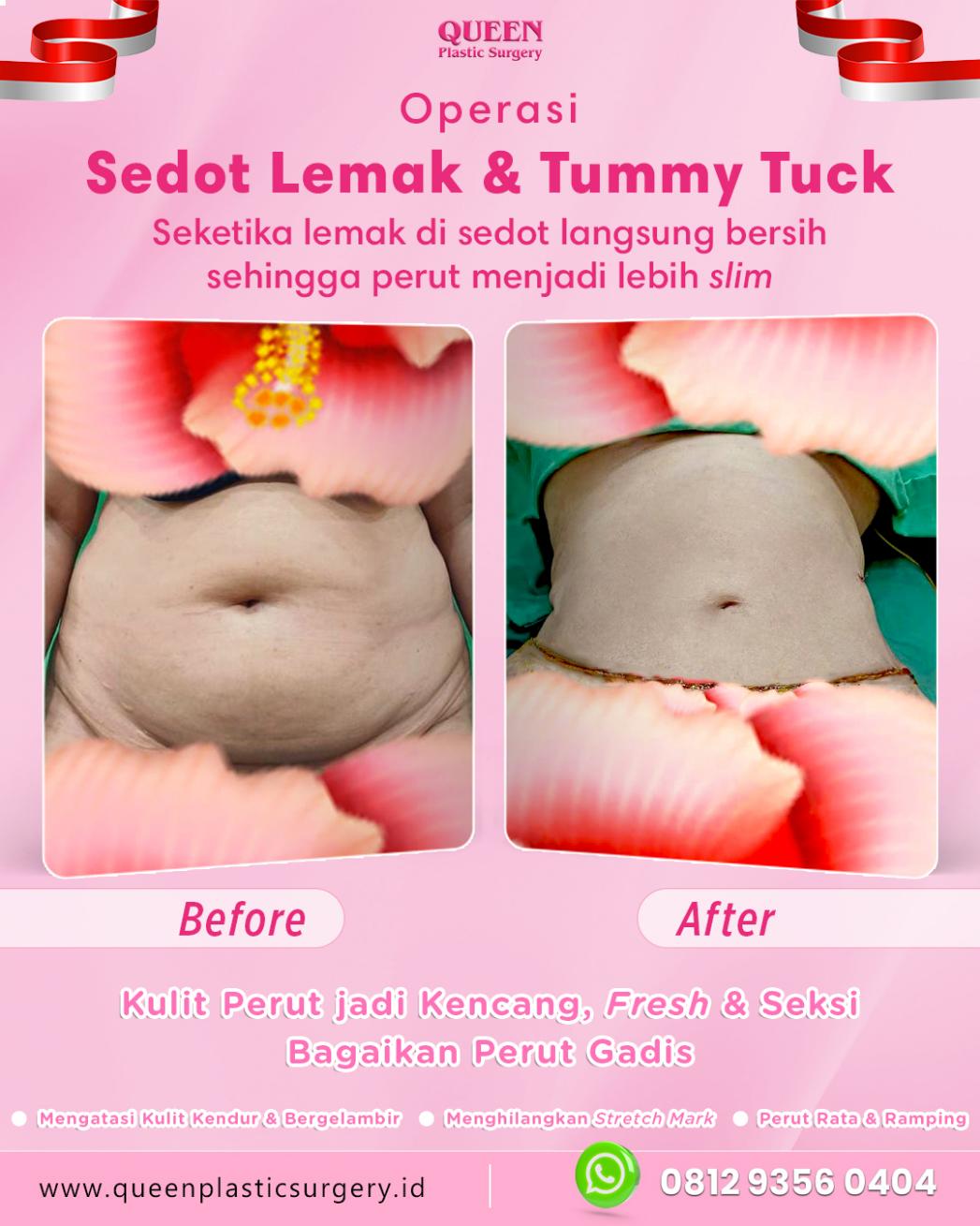 Berapa Lama Drain Setelah Tummy Tuck Dapat Bertahan? Cek Kriteria Medisnya!