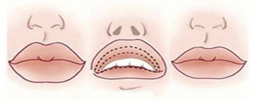 Dapatkan Senyum yang Seimbang dan Sempurna Dengan Operasi Pengecilan Bibir
