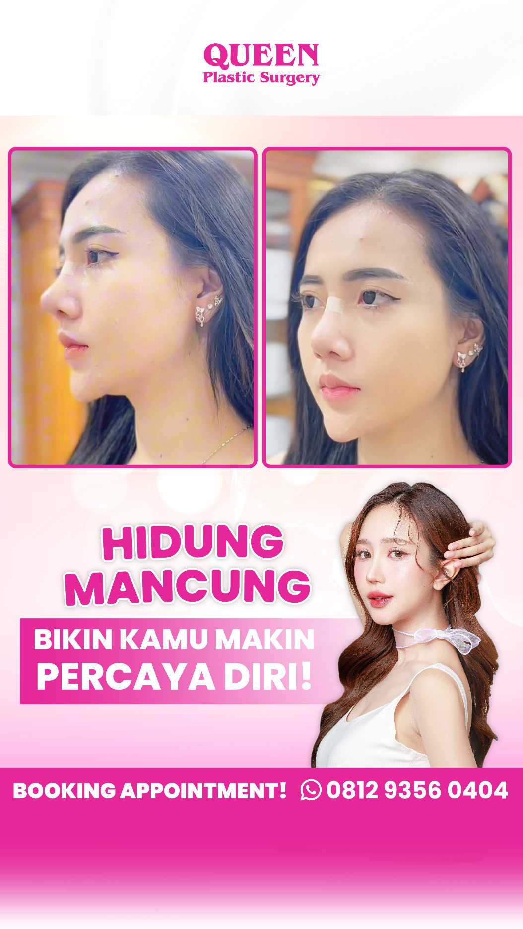 Bukan Hanya Mengubah Bentuk, Tapi Juga Mengubah Ukuran Hidung! Ini Faktanya Tentang Rhinoplasty!