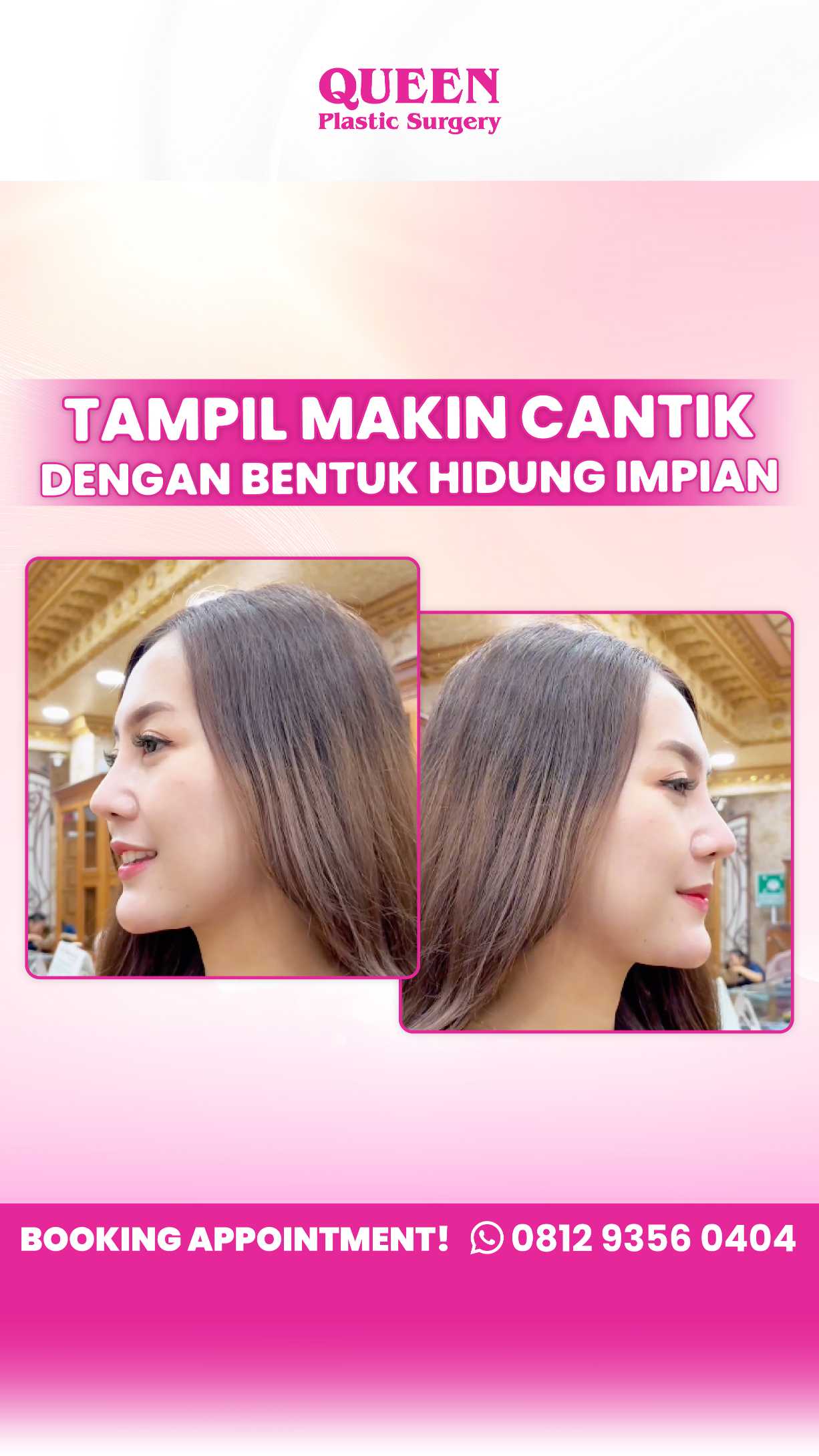 Berapa Lama Operasi Hidung Dapat Bertahan? Cari Tahu Faktanya!