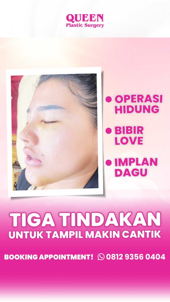 Suntikan Silikon Bikin Bibir Rusak? Ini Solusi Koreksi untuk Mengembalikan Estetika Bibir Anda