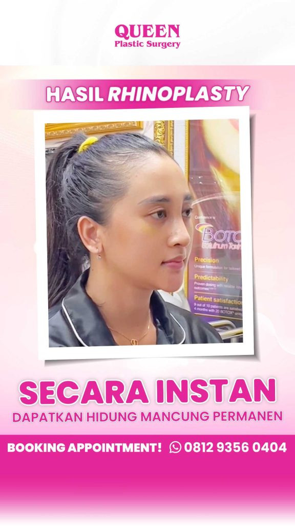 Bukan Hanya Mengubah Bentuk, Tapi Juga Mengubah Ukuran Hidung! Ini Faktanya Tentang Rhinoplasty!