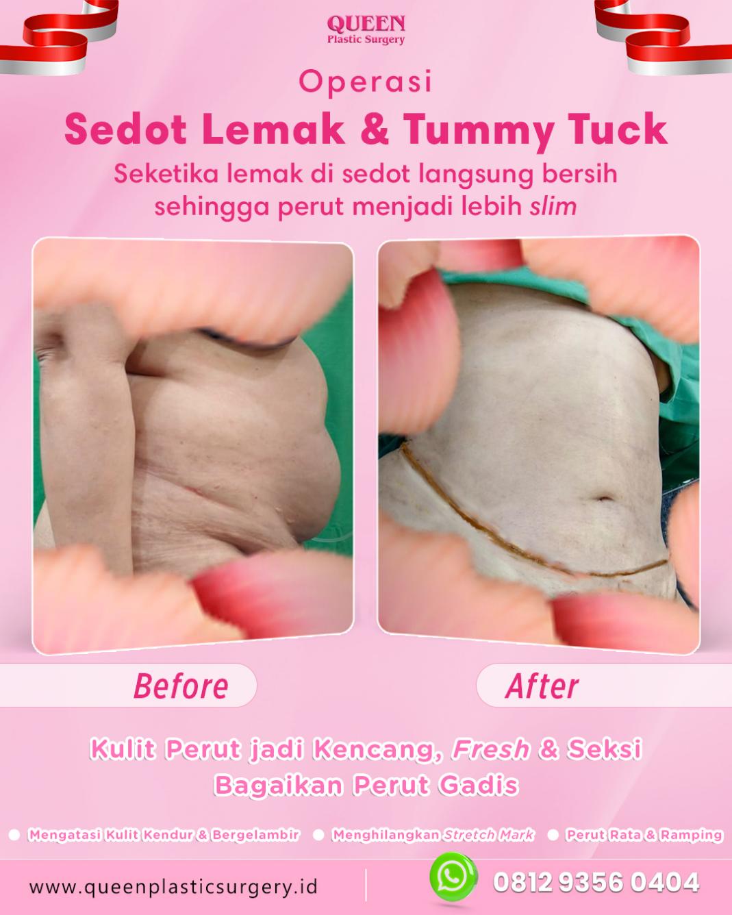 Berapa Lama Drain Setelah Tummy Tuck Dapat Bertahan? Cek Kriteria Medisnya!