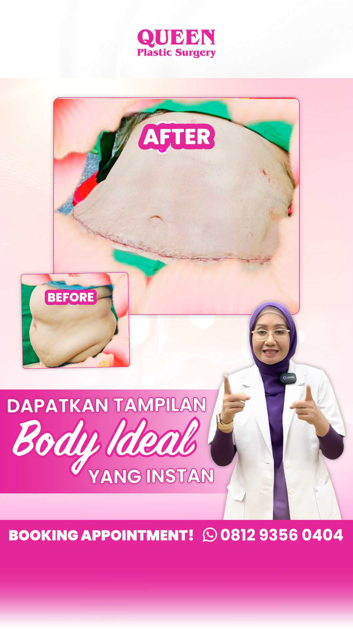 Akankah Kulit Menjadi Kencang Setelah Sedot Lemak? Ini Penjelasan Lengkapnya!