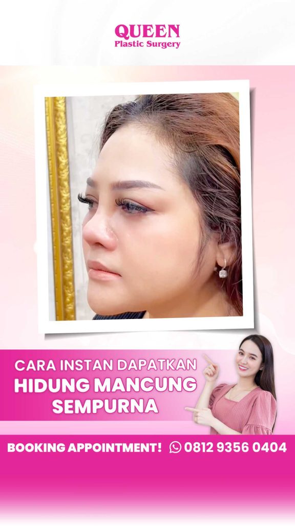 Bukan Hanya Mengubah Bentuk, Tapi Juga Mengubah Ukuran Hidung! Ini Faktanya Tentang Rhinoplasty!