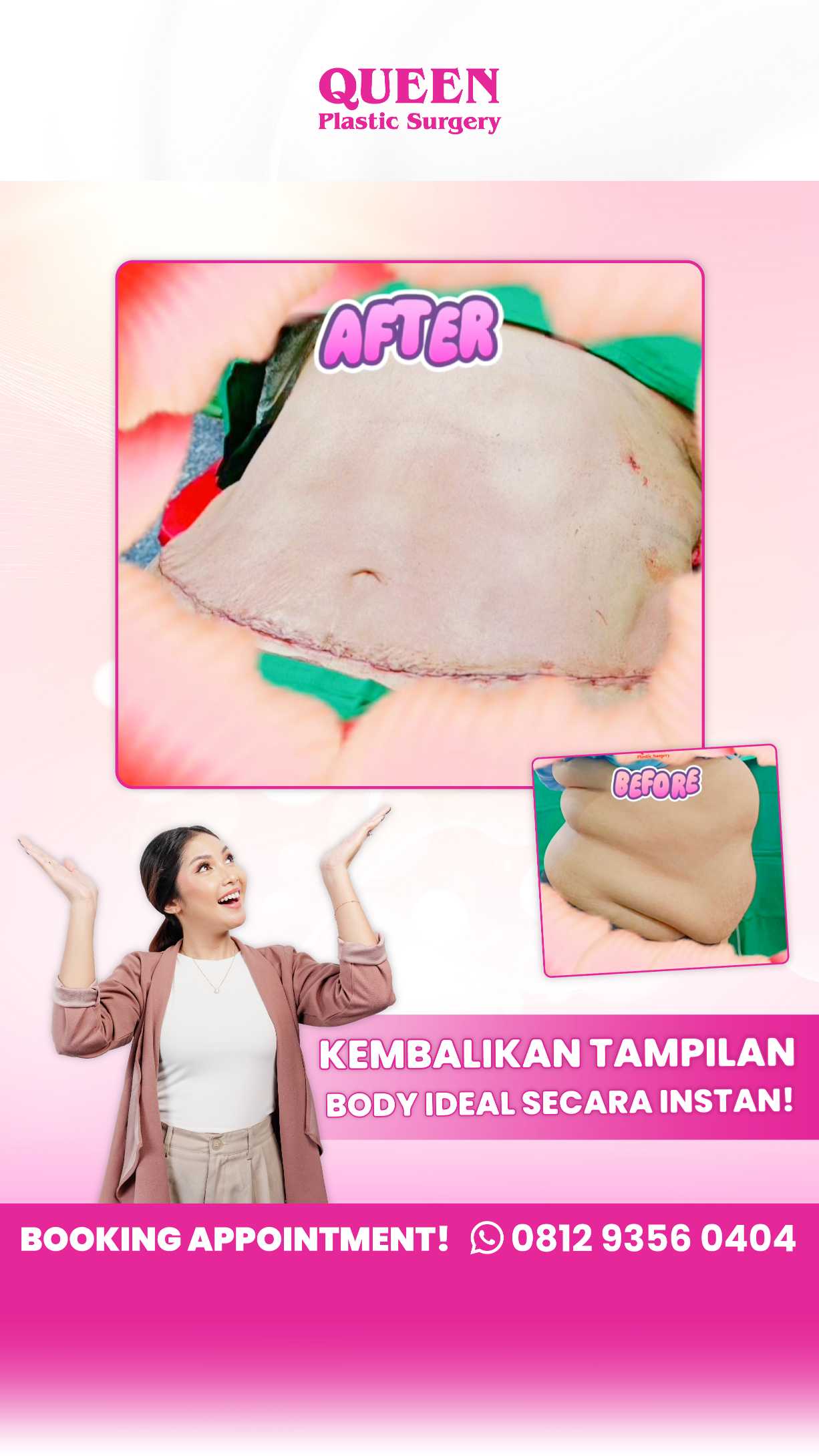 Yang Perlu Diketahui Tentang Nekrosis Lemak Pasca Operasi Tummy Tuck (Abdominoplasty)