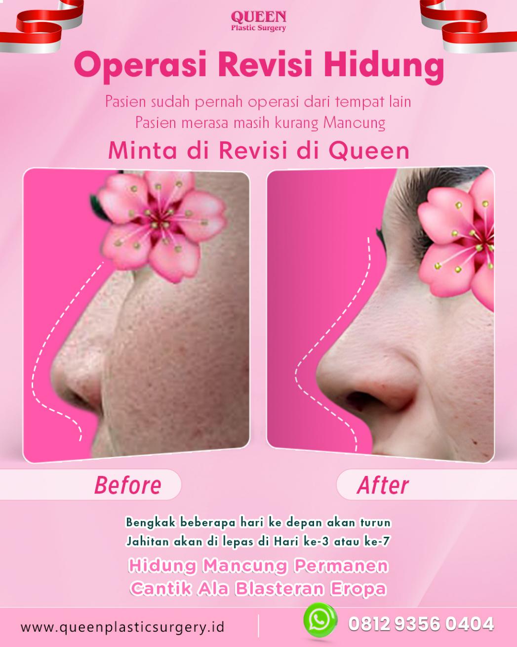 Mengenal Rhinoplasty Tulang Rusuk (Autologous Rib Cartilage), Pahami Prosedurnya!
