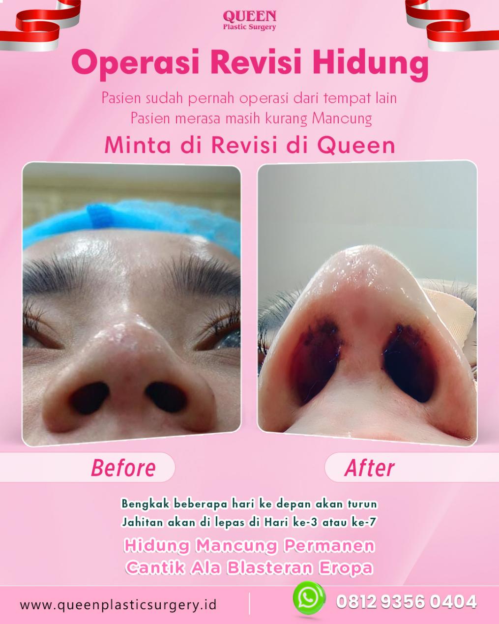 Mengenal Rhinoplasty Tulang Rusuk (Autologous Rib Cartilage), Pahami Prosedurnya!