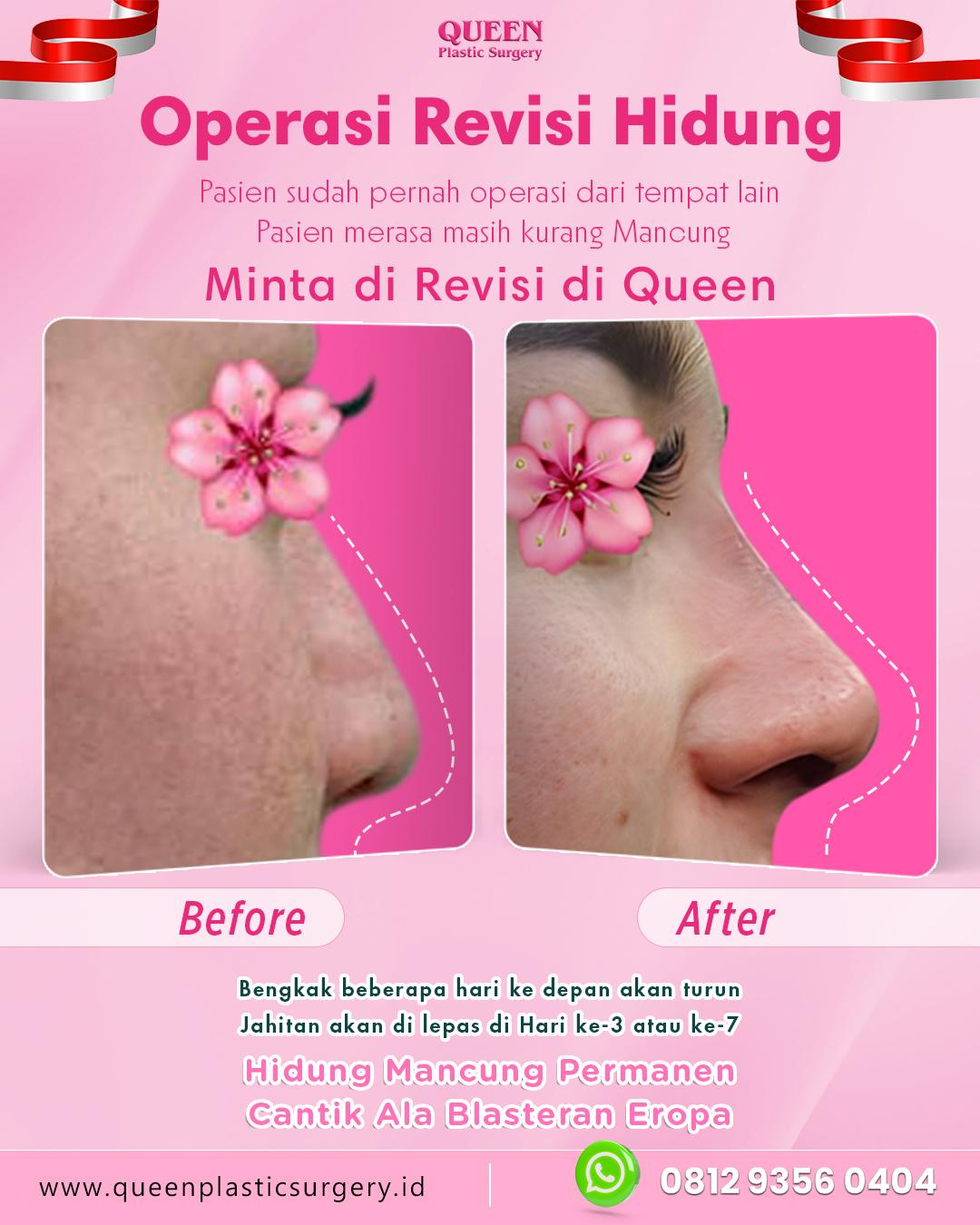 Mengenal Rhinoplasty Tulang Rusuk (Autologous Rib Cartilage), Pahami Prosedurnya!