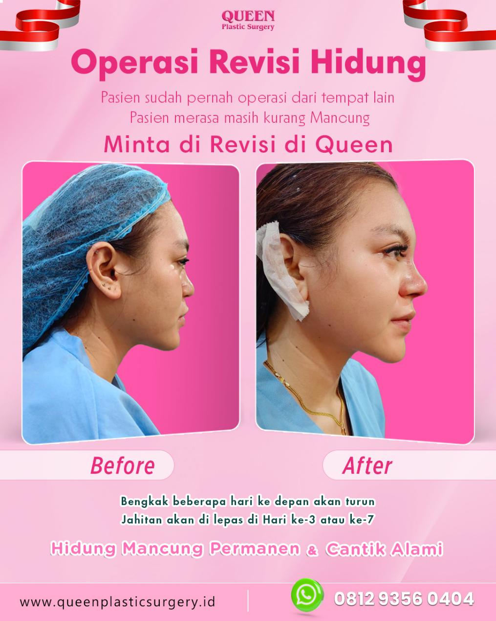 Mengenal Rhinoplasty Tulang Rusuk (Autologous Rib Cartilage), Pahami Prosedurnya!