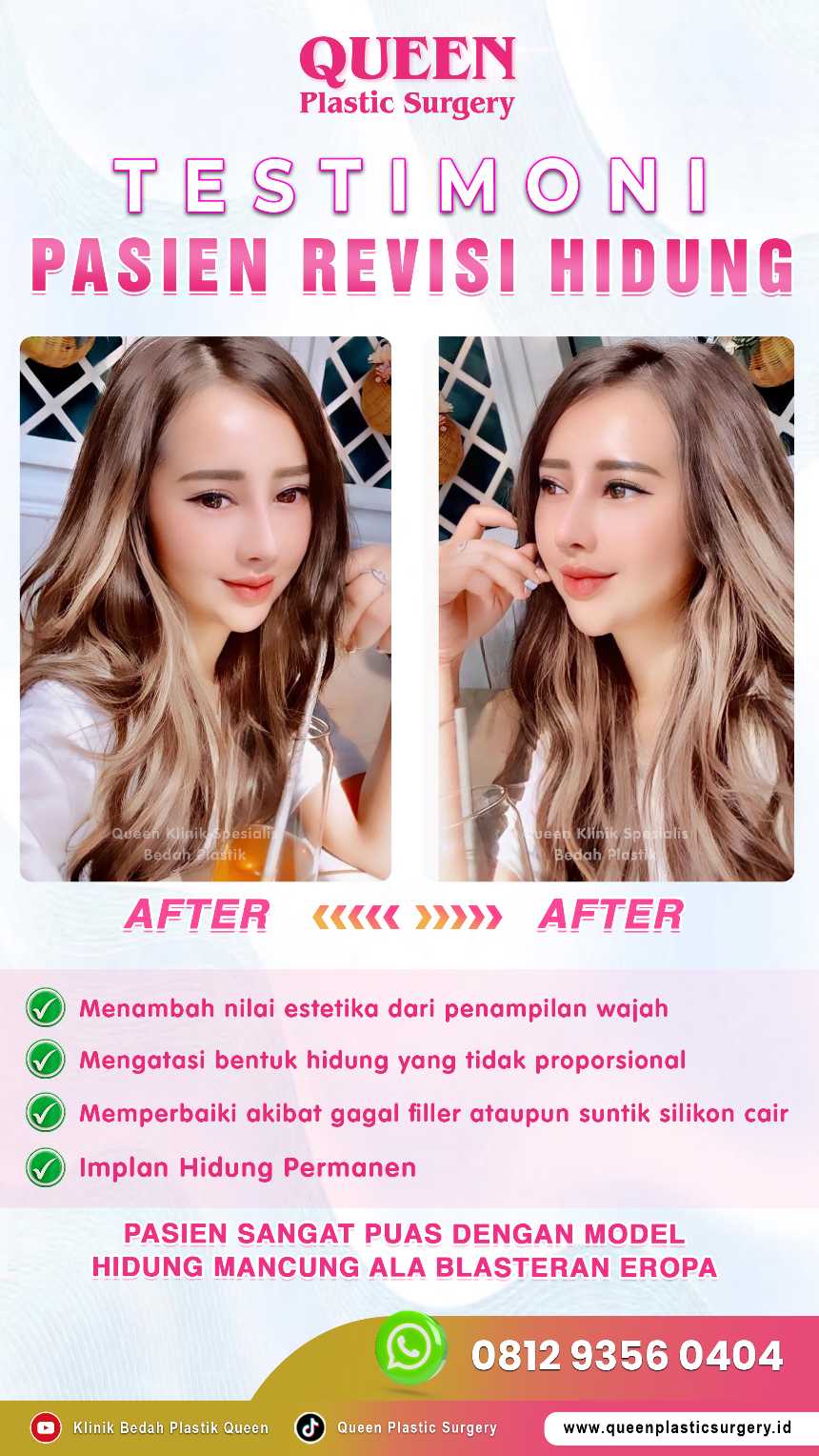 Tingkat Keberhasilan Revisi Rhinoplasty: Bisakah Hidung Kembali Sempurna? Cek Faktanya!