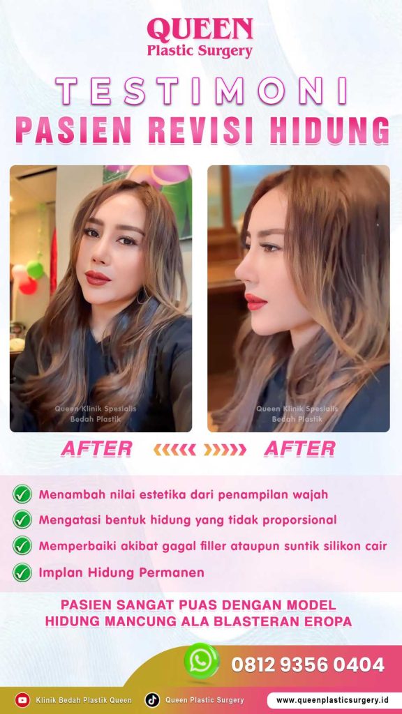 Tingkat Keberhasilan Revisi Rhinoplasty: Bisakah Hidung Kembali Sempurna? Cek Faktanya!