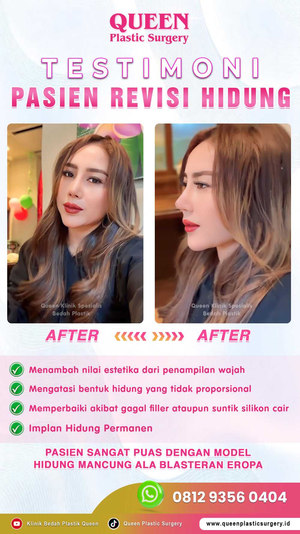 Tingkat Keberhasilan Revisi Rhinoplasty: Bisakah Hidung Kembali Sempurna? Cek Faktanya!