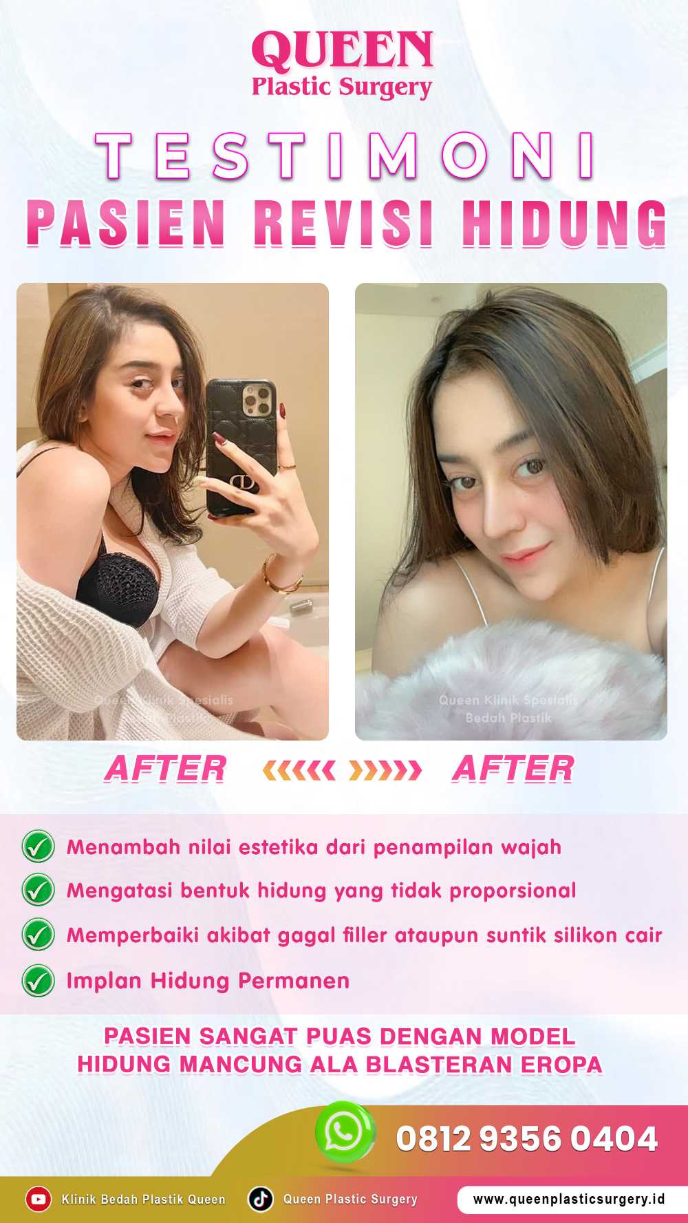 Tingkat Keberhasilan Revisi Rhinoplasty: Bisakah Hidung Kembali Sempurna? Cek Faktanya!