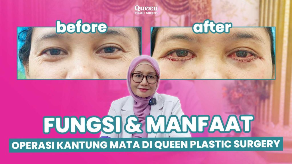 Bukan Sembarang Orang! Kenali Persyaratan Medis untuk Bisa Menjalani Blepharoplasty