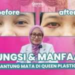 Bukan Sembarang Orang! Kenali Persyaratan Medis untuk Bisa Menjalani Blepharoplasty