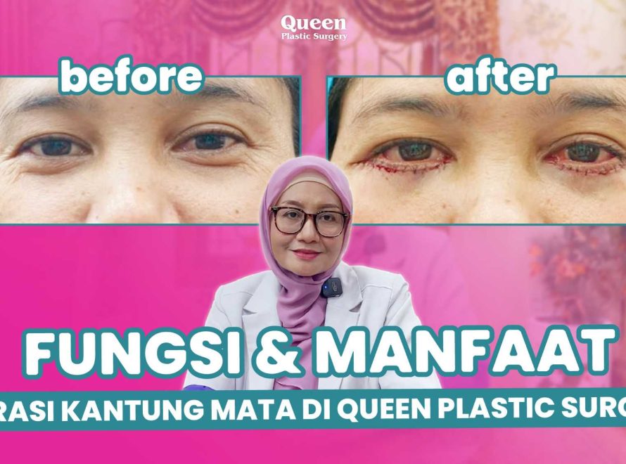 Bukan Sembarang Orang! Kenali Persyaratan Medis untuk Bisa Menjalani Blepharoplasty