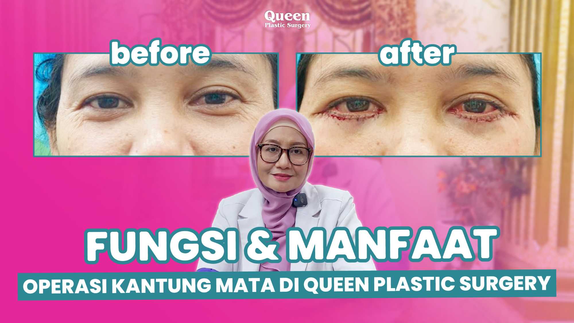 Bukan Sembarang Orang! Kenali Persyaratan Medis untuk Bisa Menjalani Blepharoplasty