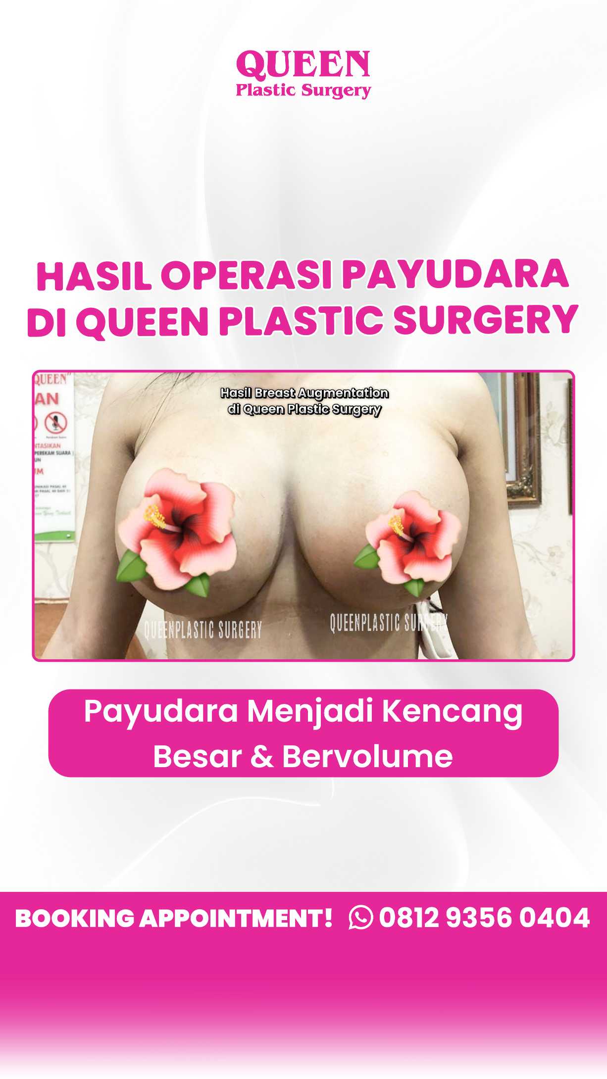 Penyebab Payudara Tuberous (Tubular Breast) dan Solusi Bedah Plastik untuk Mengoreksinya