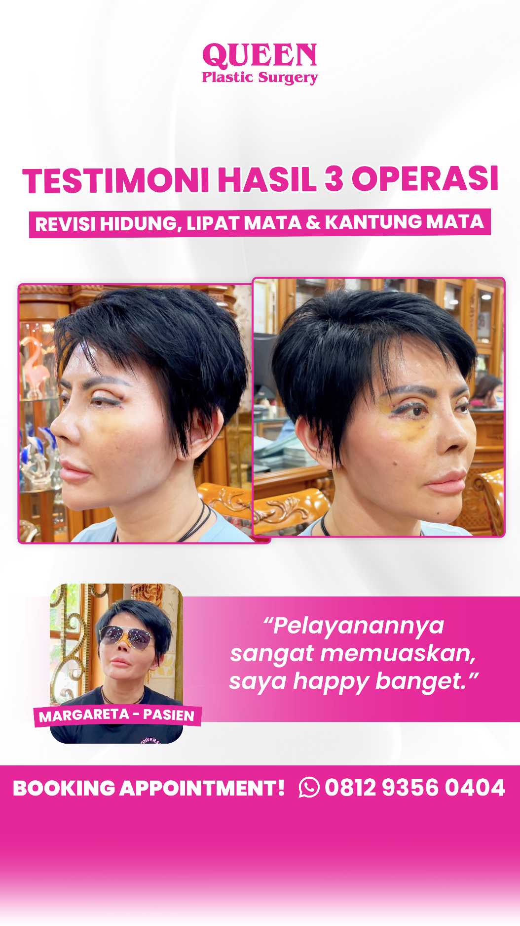 Kantung Mata Mengganggu? Ini Pilihan Perawatan Terbaik, dari Non-Invasif hingga Medis