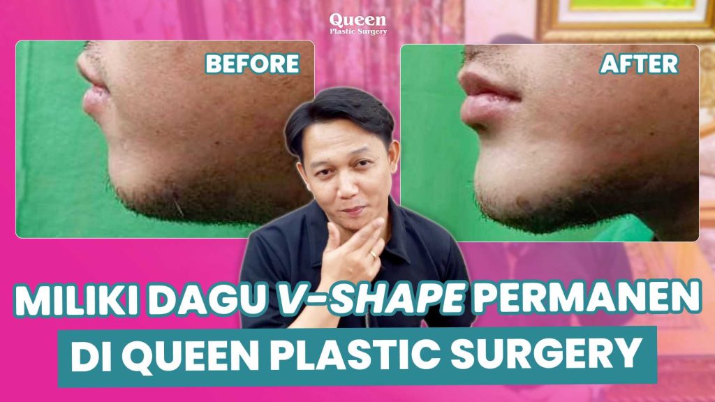 Dagu Ideal & Wajah Lebih Harmonis dengan Implan Dagu