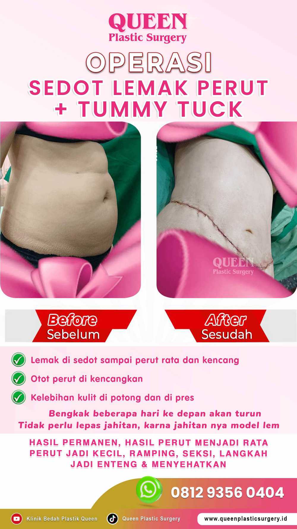 Berapa Banyak Lemak Hilang Setelah Liposuction? Temukan Batasnya!