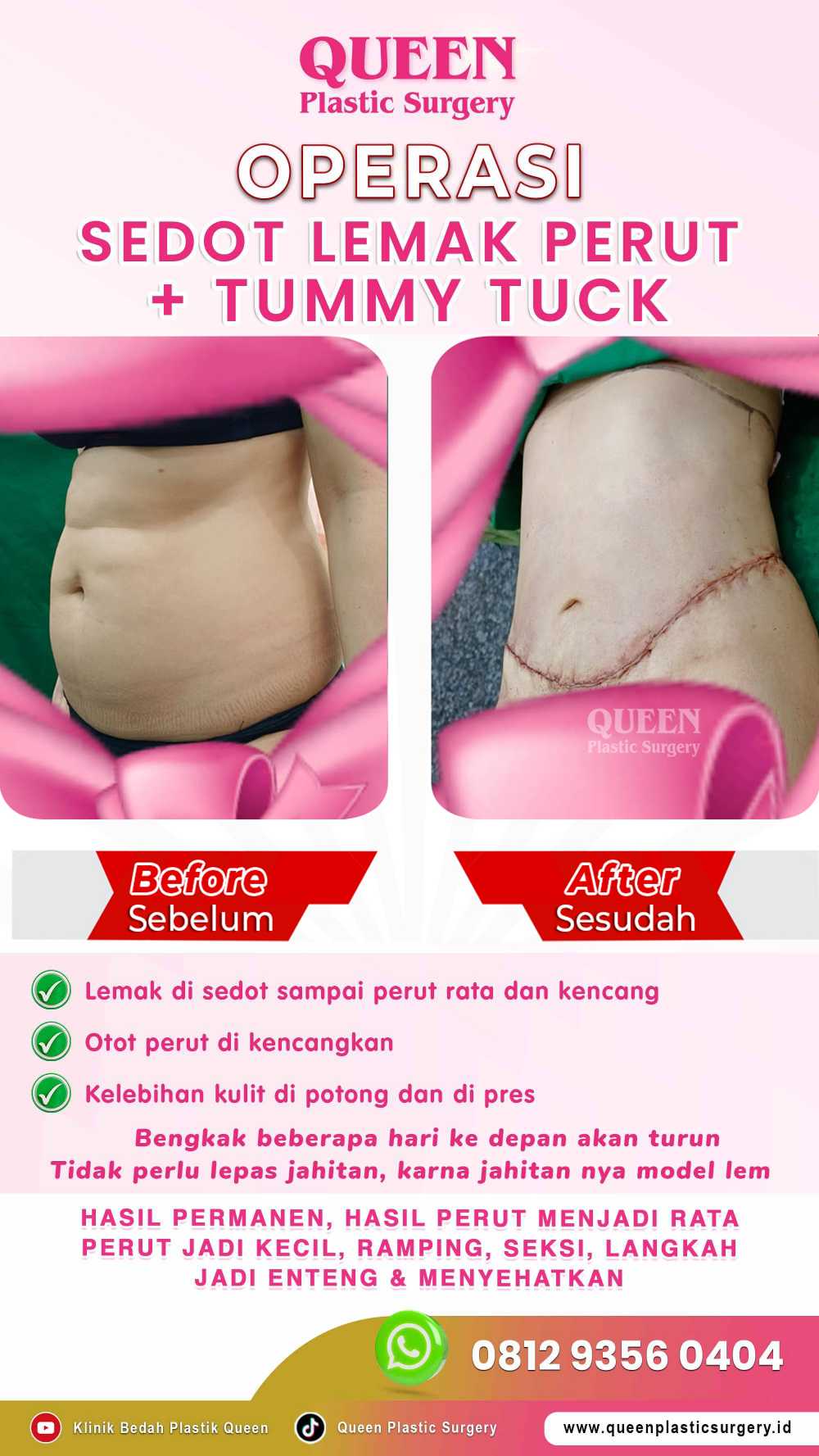 Yang Perlu Diketahui Tentang Nekrosis Lemak Pasca Operasi Tummy Tuck (Abdominoplasty)